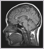 resonancia magnética del cerebro